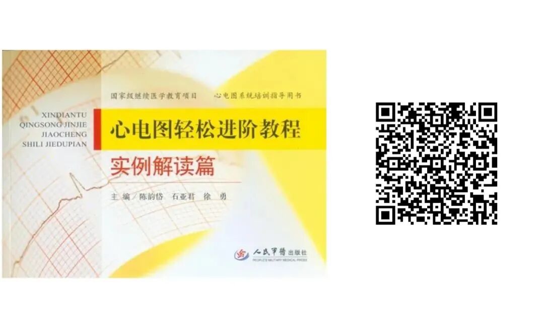 床旁心电图怎么做预售 ｜ 床旁临时心脏起搏手册，手把手教会起搏技术！_https://www.jmylbn.com_新闻资讯_第33张