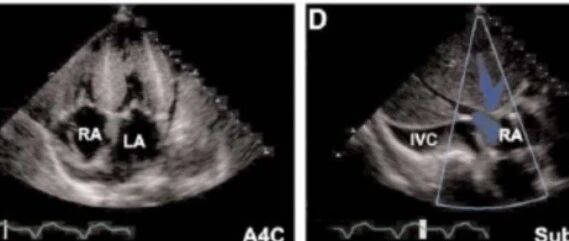 早读 | 限制型心肌病诊断要点，收藏这篇就够了！