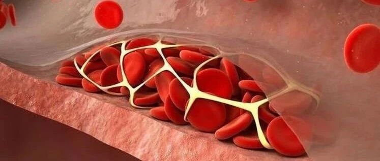 早读 | 12张动图带你领略血栓形成与转归全过程