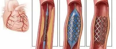 早读 | 22 组图带你真实了解冠脉支架介入术
