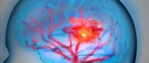 早读 | 高血压脑病常用硝普钠、甘露醇，必须知道这几件事！