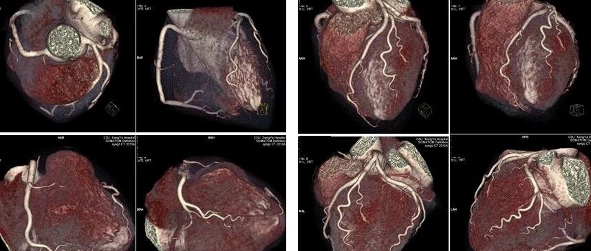 早读 | 冠脉CTA阅片要点及规范化报告，这篇值得收藏！
