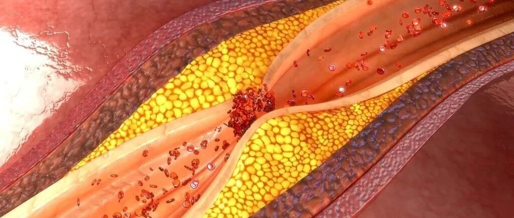 早读 | 发现颈动脉斑块，到底需不需要治疗？