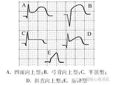 心電圖ST-T改變有哪些臨床問題，都給你總結好了！ 健康 第3張