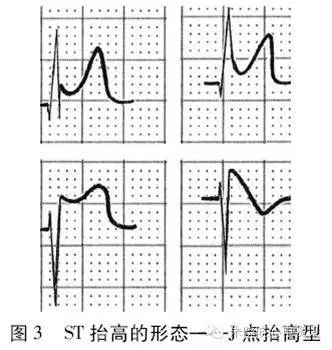 心電圖ST-T改變有哪些臨床問題，都給你總結好了！ 健康 第4張