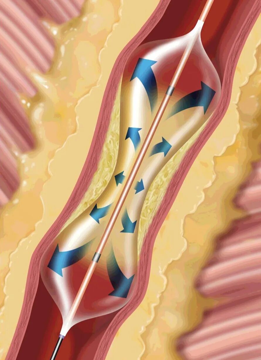 球囊是什么医疗器械一文看懂医用球囊技术知识_https://www.jmylbn.com_新闻资讯_第12张