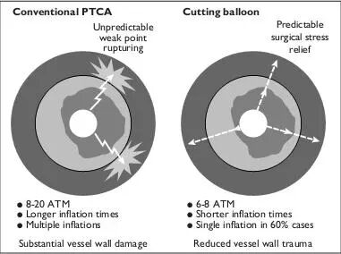 球囊是什么医疗器械一文看懂医用球囊技术知识_https://www.jmylbn.com_新闻资讯_第20张