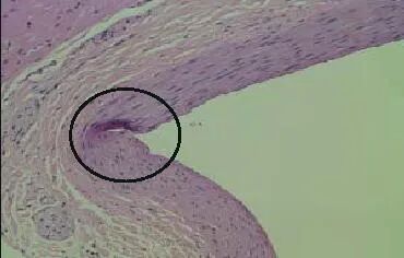 球囊是什么医疗器械一文看懂医用球囊技术知识_https://www.jmylbn.com_新闻资讯_第23张