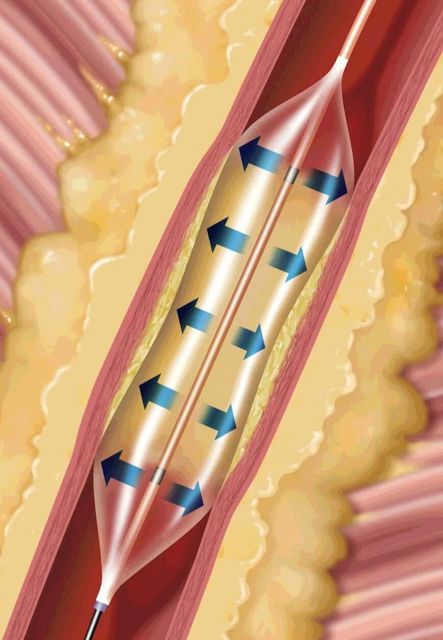 球囊是什么医疗器械一文看懂医用球囊技术知识_https://www.jmylbn.com_新闻资讯_第13张