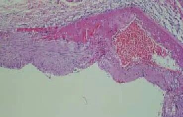 球囊是什么医疗器械一文看懂医用球囊技术知识_https://www.jmylbn.com_新闻资讯_第24张