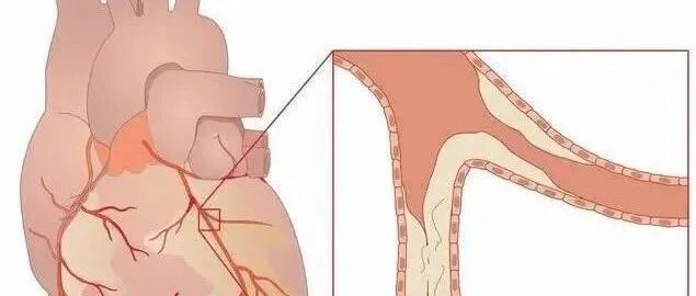 早读 | 一台完整的PCI手术是如何完成的？