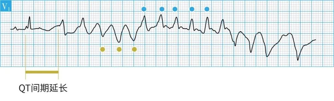恶性室性心律失常易漏诊，六大预警信号千万别错过！