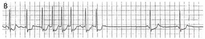 恶性室性心律失常易漏诊，六大预警信号千万别错过！