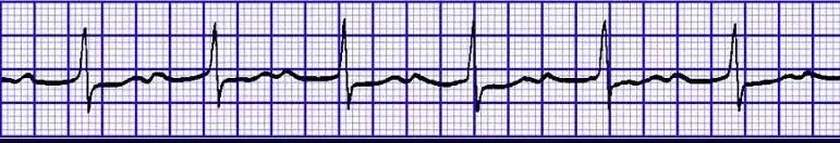 恶性室性心律失常易漏诊，六大预警信号千万别错过！