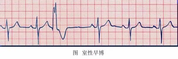 恶性室性心律失常易漏诊，六大预警信号千万别错过！
