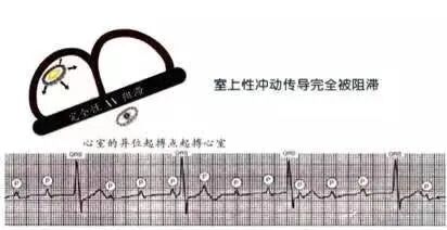 恶性室性心律失常易漏诊，六大预警信号千万别错过！