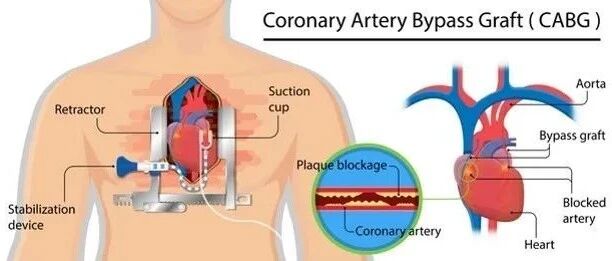 早读 | 做冠脉CT检查出“心肌桥”，这种“桥”你了解吗？