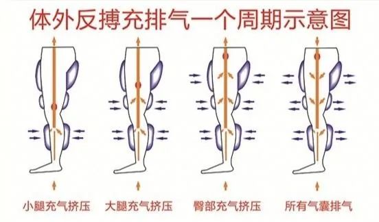 体外反搏在心脏康复中的应用