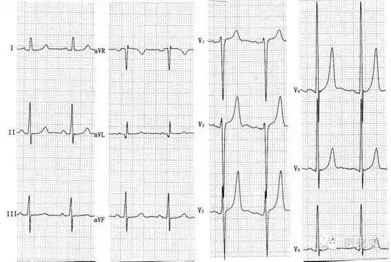 ​致命心电图，值班请牢记！