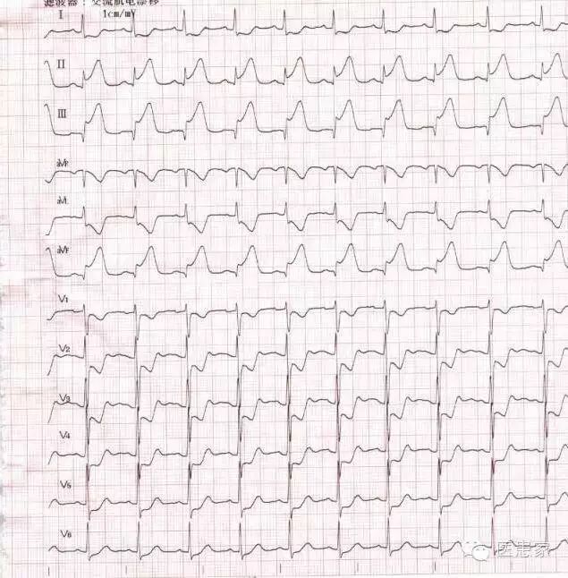 ​致命心电图，值班请牢记！