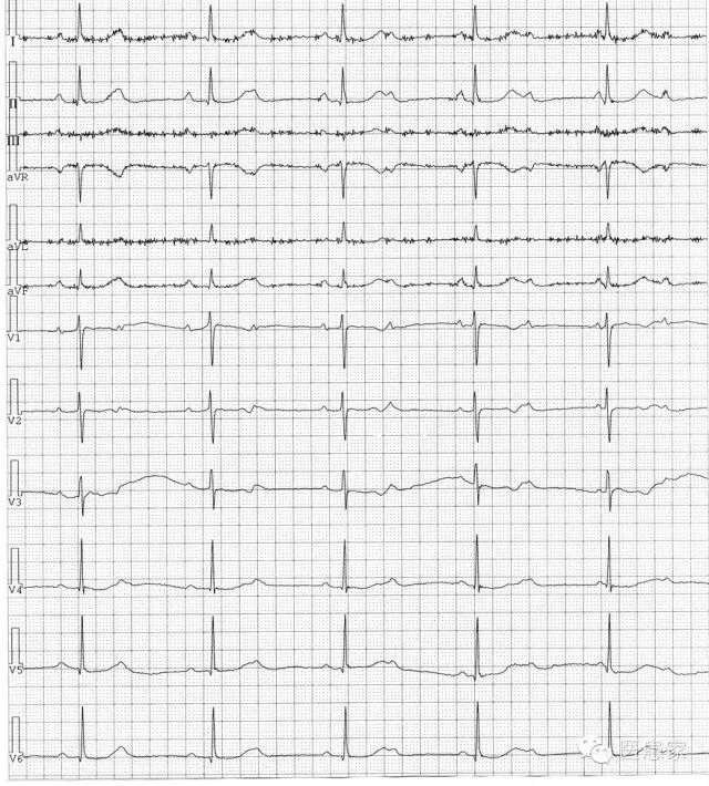 ​致命心电图，值班请牢记！