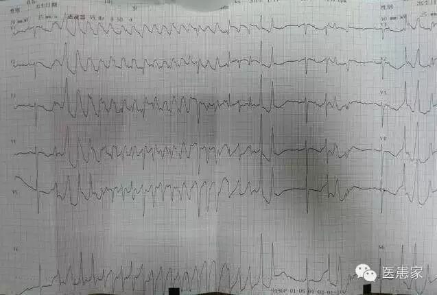 ​致命心电图，值班请牢记！