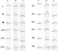 ​致命心电图，值班请牢记！