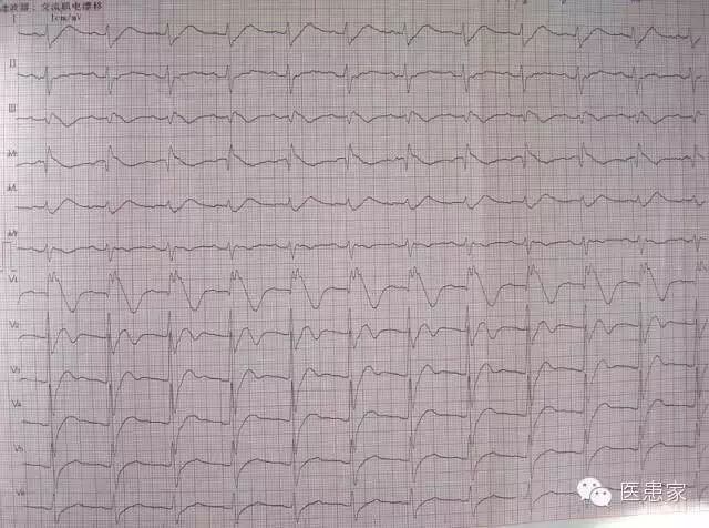 ​致命心电图，值班请牢记！