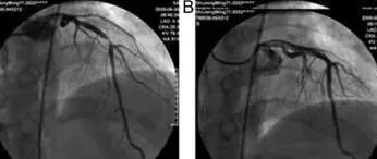 早读 | Wellens综合征与de winter ST-T波改变的异同