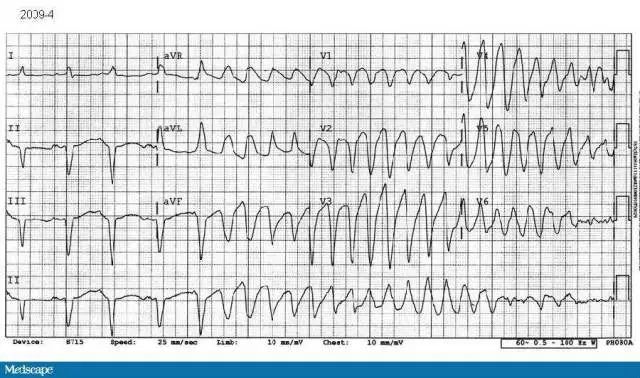 心血管必备！严重心律失常不再慌，急救处理一文搞定