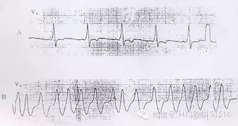 心血管必备！严重心律失常不再慌，急救处理一文搞定