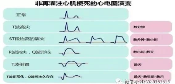 急性心梗的识别与处理！一文总结！
