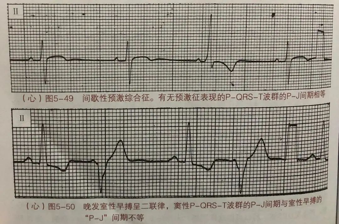原来，预激综合征也有这么多类型！