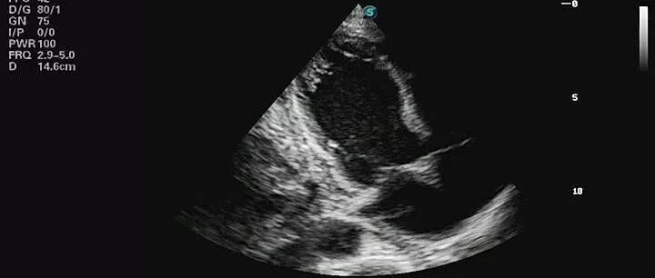 早读 | 应激性心肌病的诊治进展