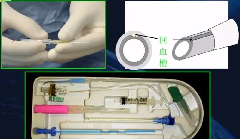 桡动脉穿刺技巧，你要知道的细节都在这！