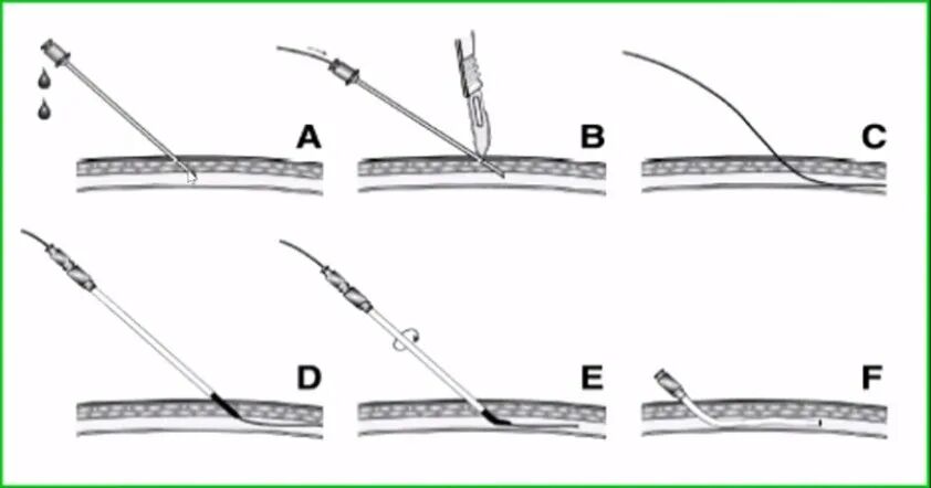 桡动脉穿刺技巧，你要知道的细节都在这！