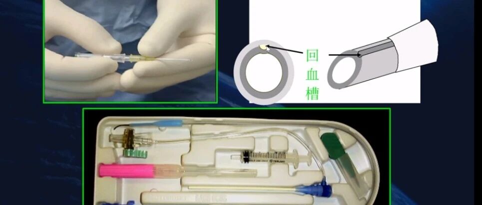 早读 | 桡动脉穿刺技巧，你要知道的细节都在这！