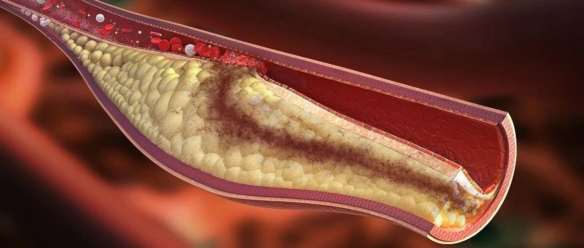 早读 | 动图演示---动脉粥样硬化的形成与危害！