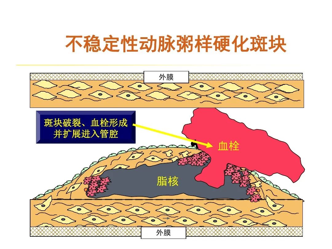太全了！急性心梗的识别与处理，赶紧存起来