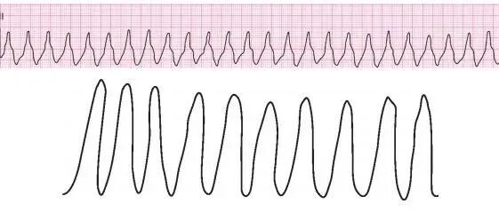 早读 | 室性心动过速，6种抗心律失常药物如何选？