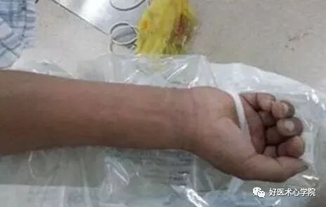 造影导丝是什么珍藏 冠脉造影从流程到诊断，基础必备！_https://www.jmylbn.com_新闻资讯_第14张