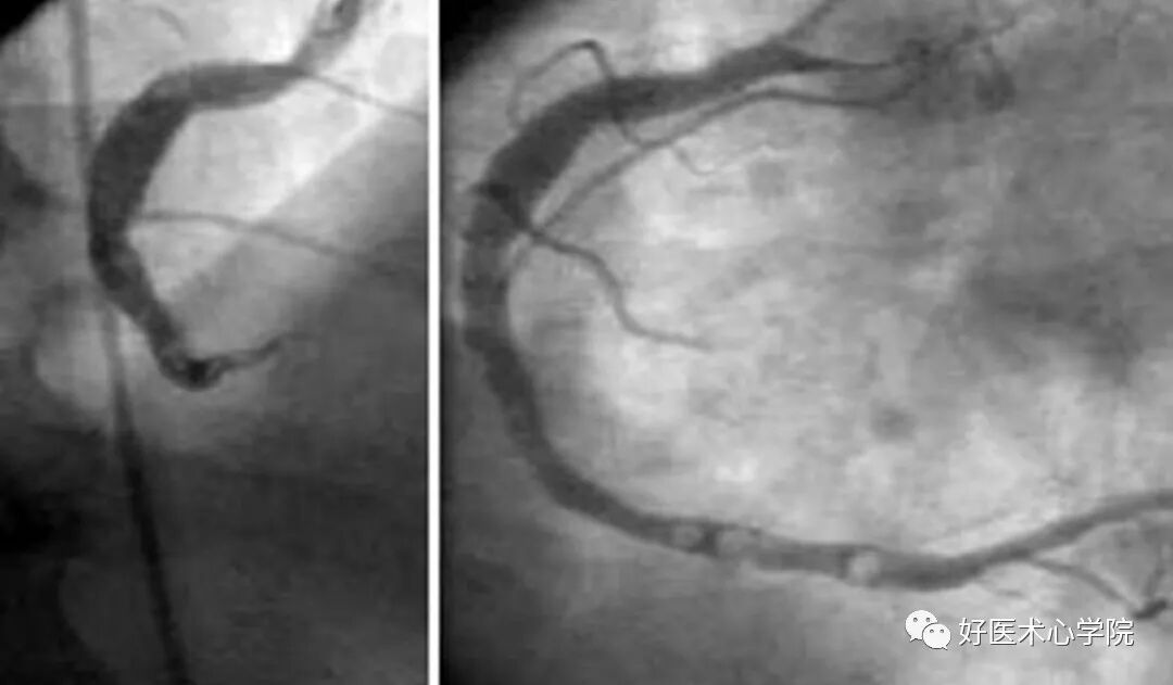 造影导丝是什么珍藏 冠脉造影从流程到诊断，基础必备！_https://www.jmylbn.com_新闻资讯_第95张