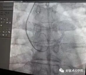 造影导丝是什么珍藏 冠脉造影从流程到诊断，基础必备！_https://www.jmylbn.com_新闻资讯_第32张