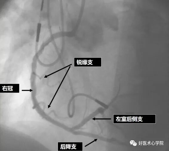 造影导丝是什么珍藏 冠脉造影从流程到诊断，基础必备！_https://www.jmylbn.com_新闻资讯_第67张