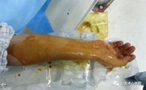 造影导丝是什么珍藏 冠脉造影从流程到诊断，基础必备！_https://www.jmylbn.com_新闻资讯_第15张