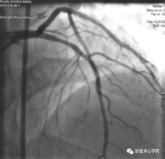 造影导丝是什么珍藏 冠脉造影从流程到诊断，基础必备！_https://www.jmylbn.com_新闻资讯_第83张