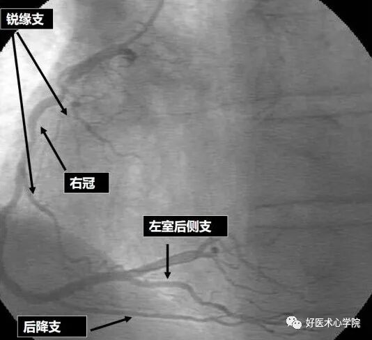 造影导丝是什么珍藏 冠脉造影从流程到诊断，基础必备！_https://www.jmylbn.com_新闻资讯_第71张