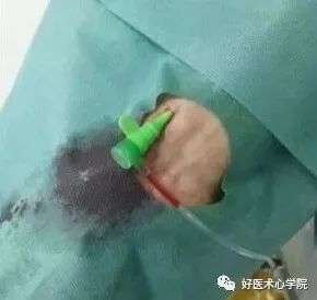 造影导丝是什么珍藏 冠脉造影从流程到诊断，基础必备！_https://www.jmylbn.com_新闻资讯_第29张