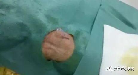 造影导丝是什么珍藏 冠脉造影从流程到诊断，基础必备！_https://www.jmylbn.com_新闻资讯_第24张