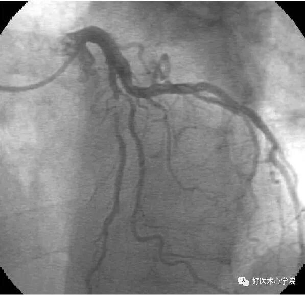 造影导丝是什么珍藏 冠脉造影从流程到诊断，基础必备！_https://www.jmylbn.com_新闻资讯_第60张
